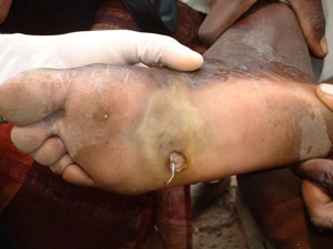 Emergence of a Guinea worm from a foot. Photo credit: E. Wolfe, 2003,The Carter Center.