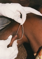 Guinea worm extraction from leg