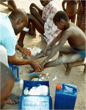 Painful extraction of a Guinea worm. Credit: The Carter Center/Louise Gubb, 2007