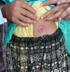 Ulcerative skin lesion, with a raised outer border, on a Guatemalan patient who has cutaneous leishmaniasis. (Credit: MERTU, Guatemala; courtesy of B. Arana)