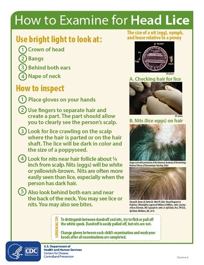 How to Examine for Head Lice