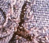 The seams of this piece of clothing contain lice eggs from body lice. (CDC Photo. Courtesy of Reed & Carnrick Pharmaceuticals)