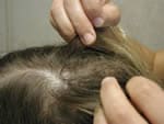 Examination of hair and scalp for head lice. Close examination of the hair and scalp is necessary to determine head lice infestation. (CDC Photo)