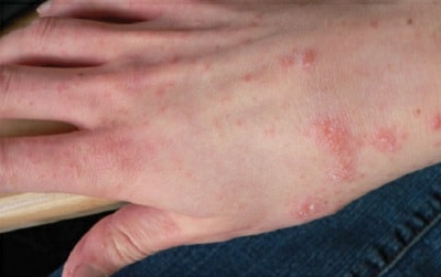 Rash Early Stage Scabies Images