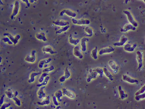 Infezione da Naegleria fowleri (ameba mangia-cervello)