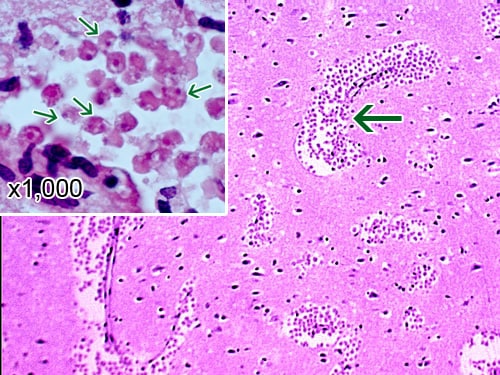 A section of the cerebral portion of the brain from a PAM patient, stained with hematoxylin and eosin, showing large clusters of Naegleria fowleri trophozoites and the destruction of the normal brain tissue architecture. Cysts are not seen. Magnification: 100x. Inset: Higher magnification (1000x) of Naegleria fowleri trophozoites (arrows) with the characteristic nuclear morphology.