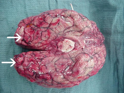 Extensive hemorrhage and necrosis is present in the brain, mainly in the frontal cortex.