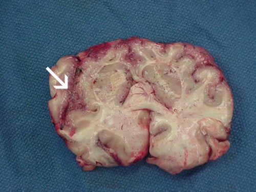 Focal hemorrhage and necrosis in frontal cortex due to Naegleria fowleri