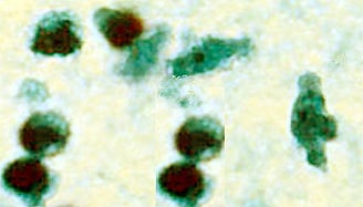 Trophozoite in CSF, stained with trichrome. Image courtesy of the Texas State Health Department.