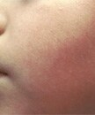 Left side of this boy&rsquo;s face displaying signs of erythema infectiosum, or Fifth disease.