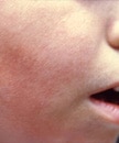 Right side of this boy's face displaying signs of erythema infectiosum, or Fifth disease.