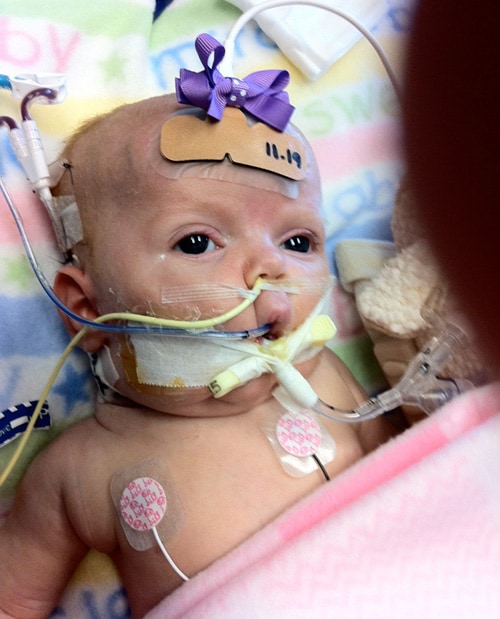 Bebé en la cama de un hospital con tubos en su cabeza, boca y nariz.
