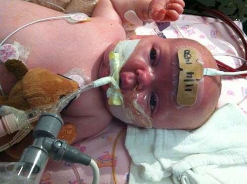 Baby in a hospital bed with tubes in their head, mouth, and nose.