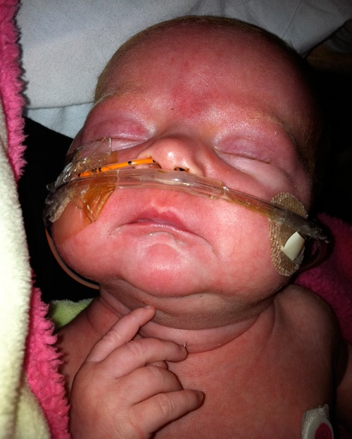 Bebé en la cama de un hospital con tubos en su nariz.