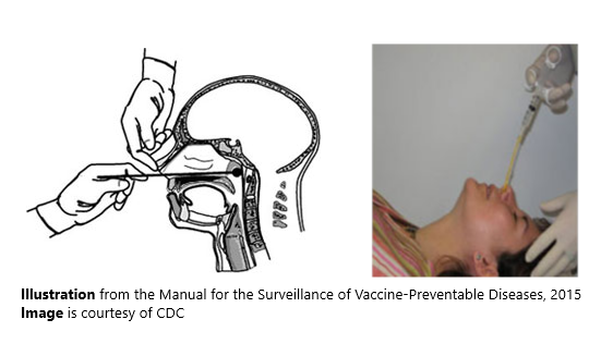 An illustration and image showing the proper technique for obtaining a nasopharyngeal specimen for isolation of Bordetella pertussis.