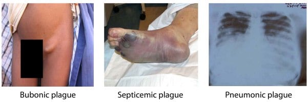 Three images showing different forms of plague.  The first one showing a person with bubonic plage which is shows a large lump in his groin, the second is of Septicemic plague which shows a person's foot that is swollen and bruised, and the third image is Pneumonic plague which shows an ex-ray of a persons lungs. 