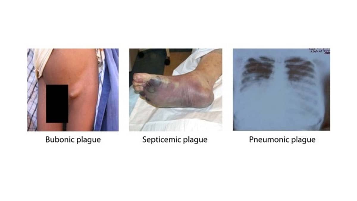 3 images showing different forms of plague. The first one shows a person with bubonic plague which shows a large lump in his groin, the second is of septicemic plague which shows a person's foot that is swollen and dying tissue, and the third image is of pneumonic plague which shows an x-ray of a person's lungs.