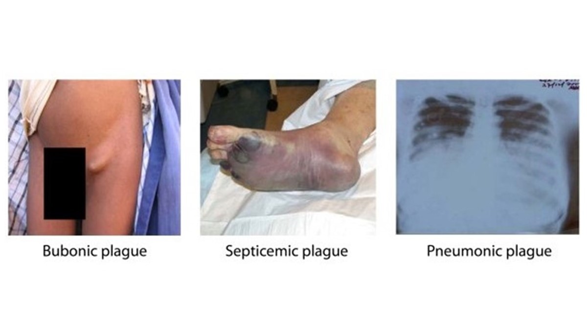 3 images showing different forms of plague. The first one shows a person with bubonic plague which shows a large lump in his groin, the second is of septicemic plague which shows a person's foot that is swollen and dying tissue, and the third image is of pneumonic plague which shows an x-ray of a person's lungs.