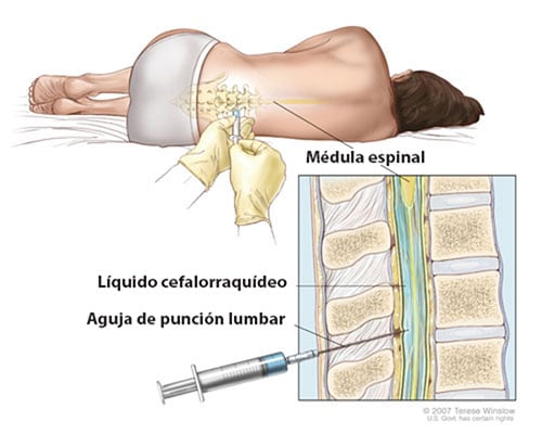 una mujer acostada de lado recibiendo una punción en la parte inferior de la espalda, y una imagen de primer plano del procedimiento