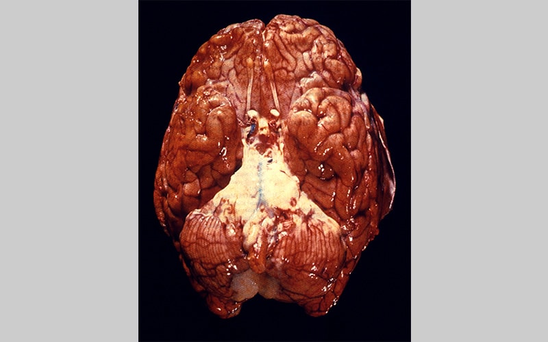 Ventral view of a human brain depicts a purulent basilar meningitis infection due to Streptococcus pneumoniae bacteria