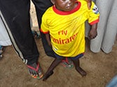 Child in Nigeria with a leg partly paralyzed from polio
