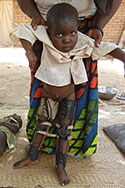 A young girl with leg braces following poliomyelitis, Chad (Photo by Minal Patel, STOP volunteer).