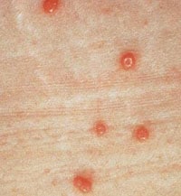 Typical molluscum bumps. Note the pearly appearance and the dimple in the center of the bumps. Image courtesy L. Sperling, MD, Walter Reed Army Medical Center