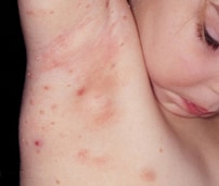 Molluscum bumps on a child. Image courtesy Scott Norton MD, MPH, Dept. of Dermatology, Walter Reed Army Medical Center