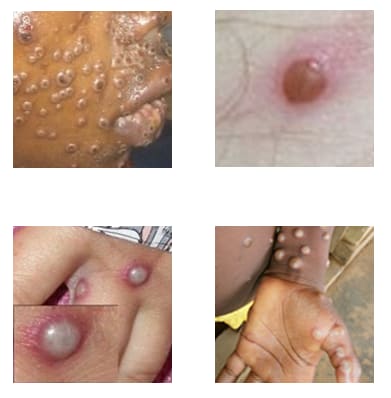 Key characteristics of Monkeypox rash