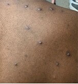monkeypox rash with blisters spread on back