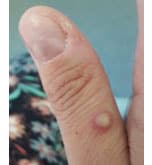 rash on thumb