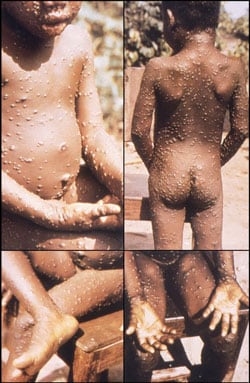 Image of a child affected with monkeypox. 