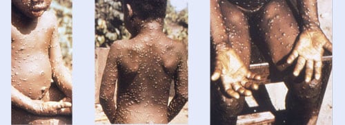 Images of a child with monkeypox, a lab worker, and vaccine. 