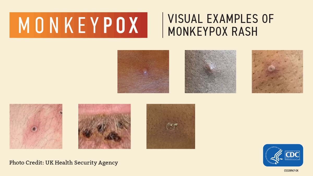 more examples of monkeypox rash