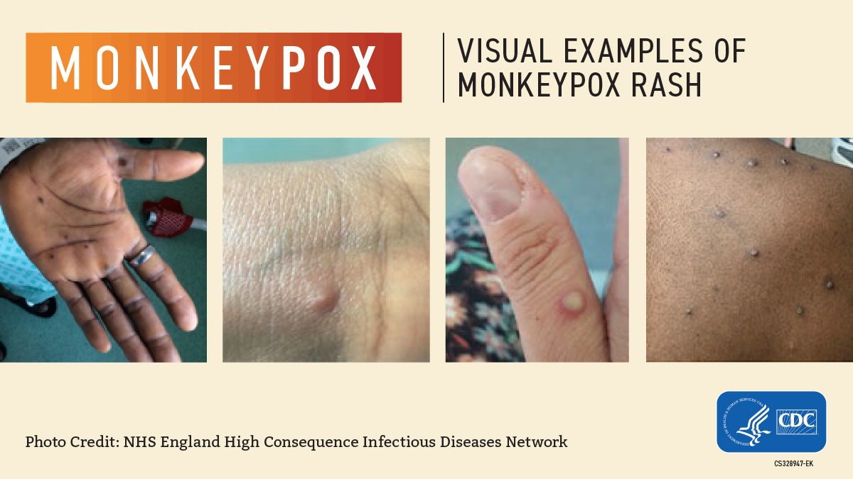 4 images of lesions to help identify monkeypox rash