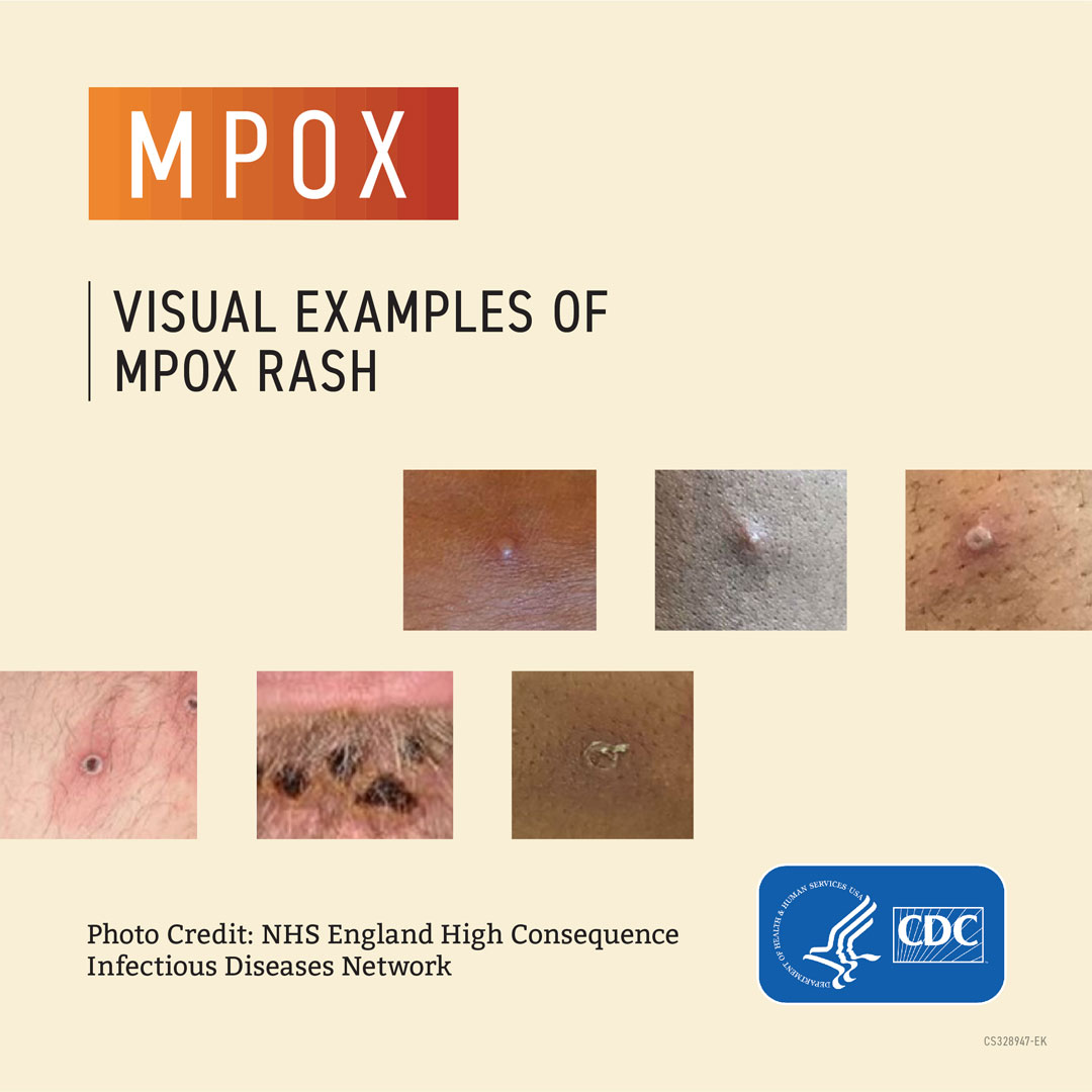 Visual examples of monkeypox rash. Graphic includes photos of monkeypox bumps and pox on different skin tones.