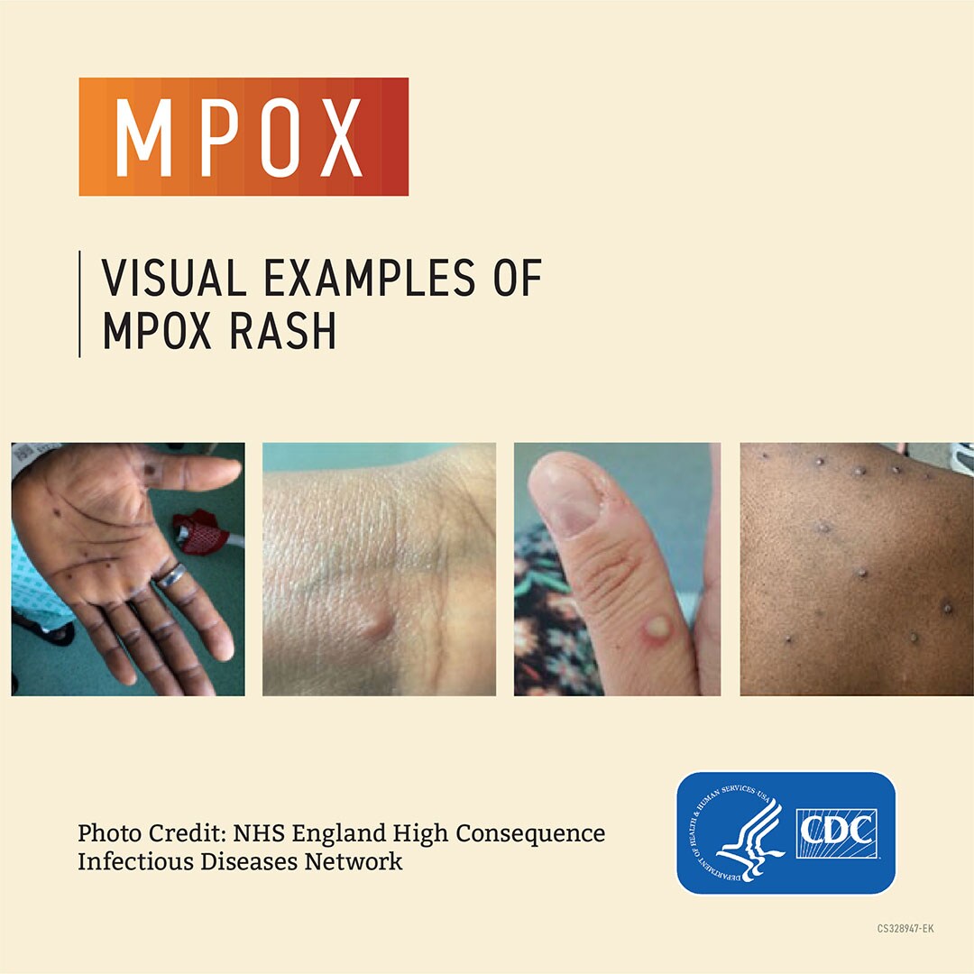 Visual examples of monkeypox rash. Graphic includes photos of monkeypox bumps and pox on different skin tones.