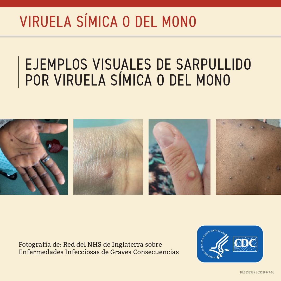 Ejemplos visuales de sarpullido de la viruela símica o del mono