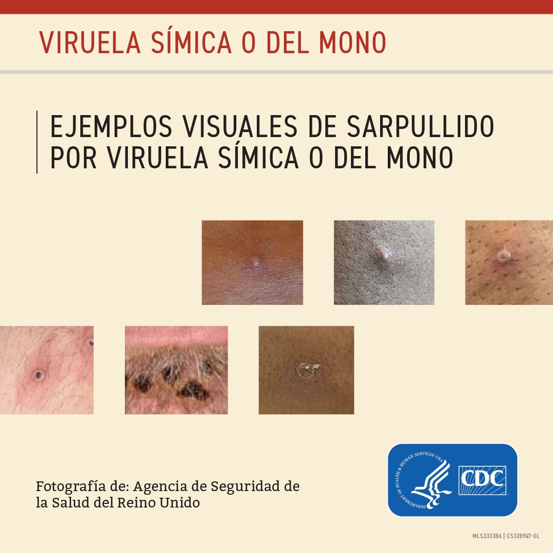 Ejemplos visuales de sarpullido por viruela símica o del mono