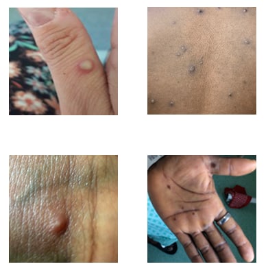 Clinical Recognition, Mpox, Poxvirus