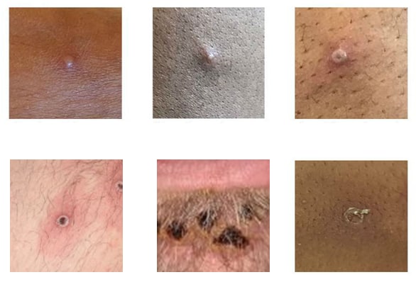 six images of lesions to help identify mpox rash