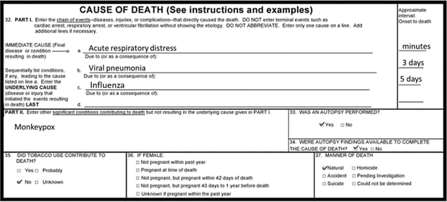 A cause of death form shows the immediate cause is listed as acute respiratory distress, and the underlying causes are listed as viral pneumonia, and influenza. Under other significant conditions contributing to death but not result in the underlying cause, the form lists monkeypox.