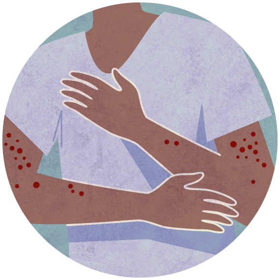 Illustration of person with rashes on his arms