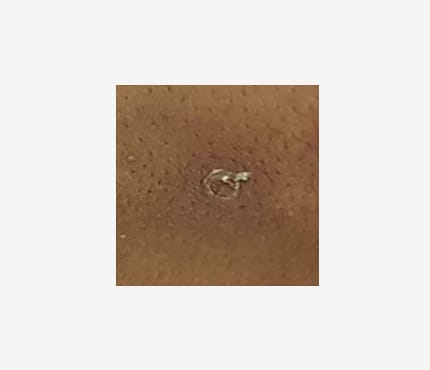 Fotos del sarpullido de la viruela símica (mpox en inglés)