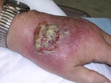 Orf virus infection on the hand of a person with a weak immune system.