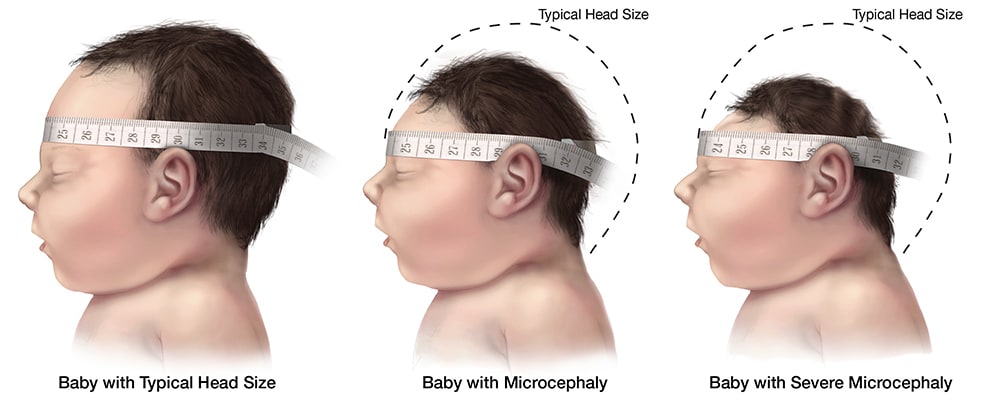 Image showing a baby with an typical size head, a baby with microcephlay, and a baby with severe micorcephaly