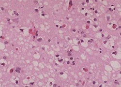 Classic CJD is a human prion disease. It is a neurodegenerative disorder with characteristic clinical and diagnostic features.