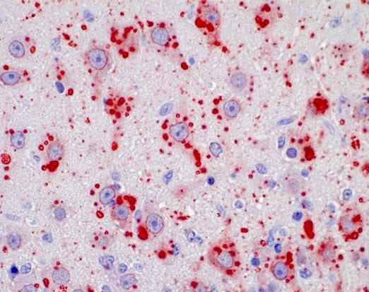 Positive IHC; rabies-infected neronal cells of the brain