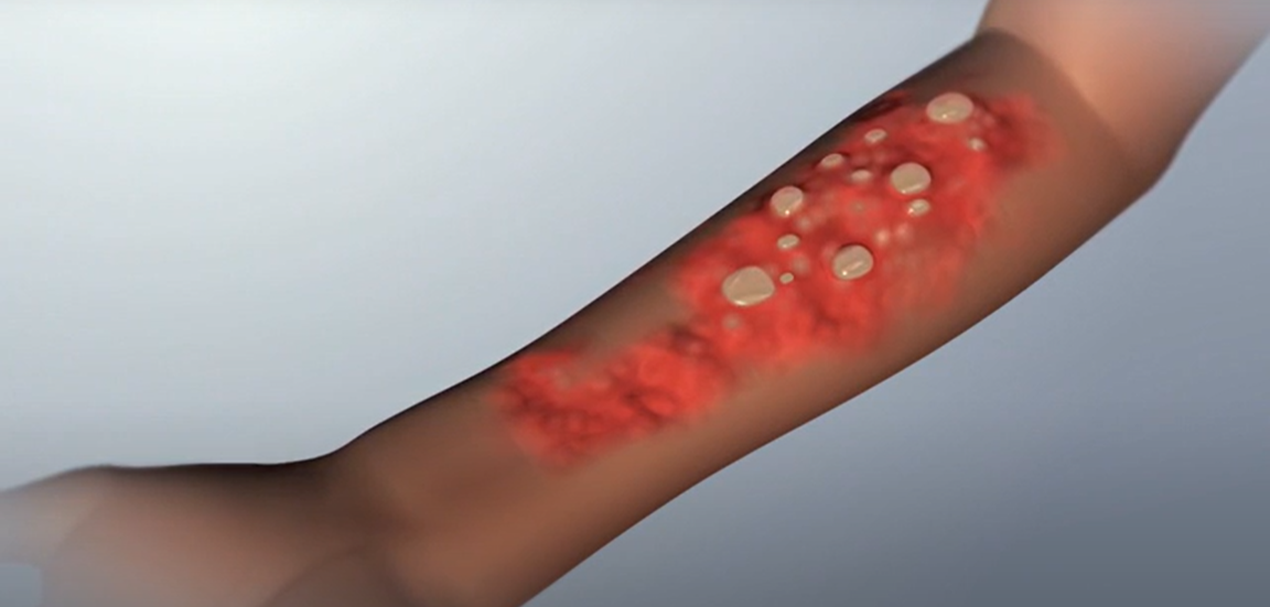 Brazo con lesiones cut&aacute;neas por radiaci&oacute;n