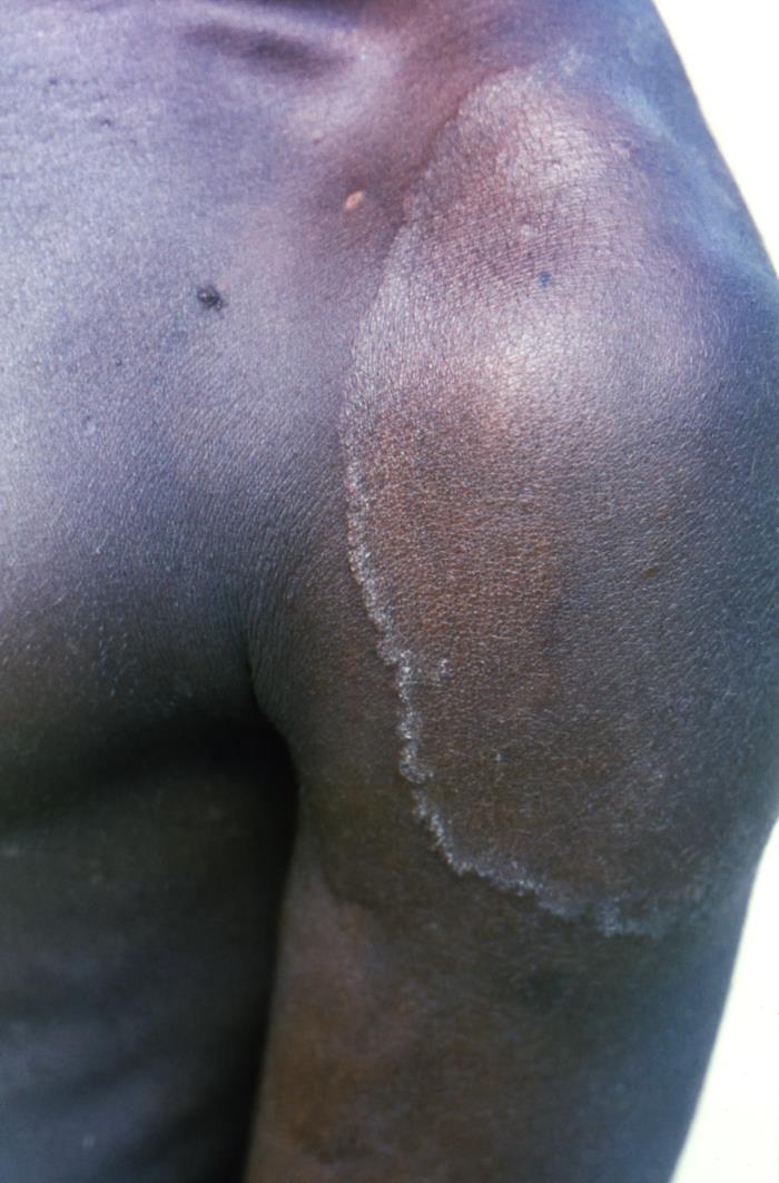 shoulder of a dark-skinned man with a large lesion